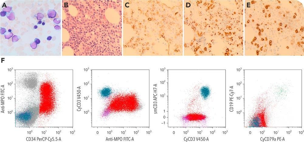 T/myeloid MPAL with biallelic CEBPA mutations